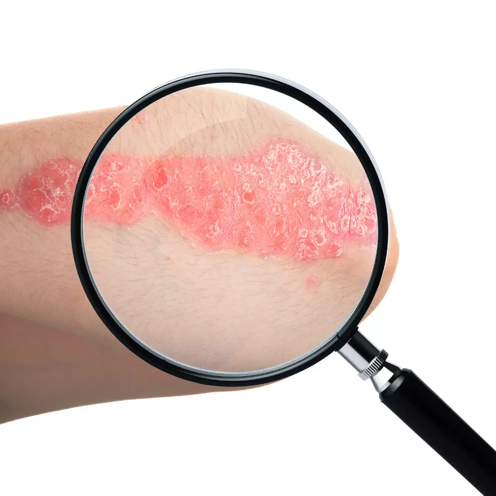 Psoriasis