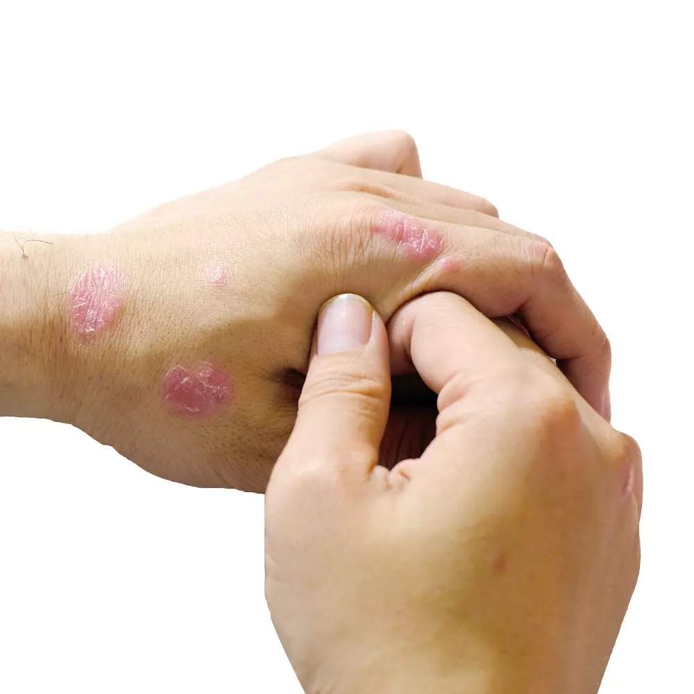 Dermatitis por contacto