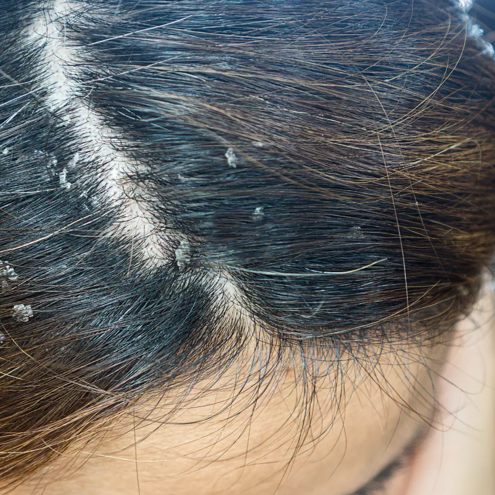 Dermatitis seborreica
