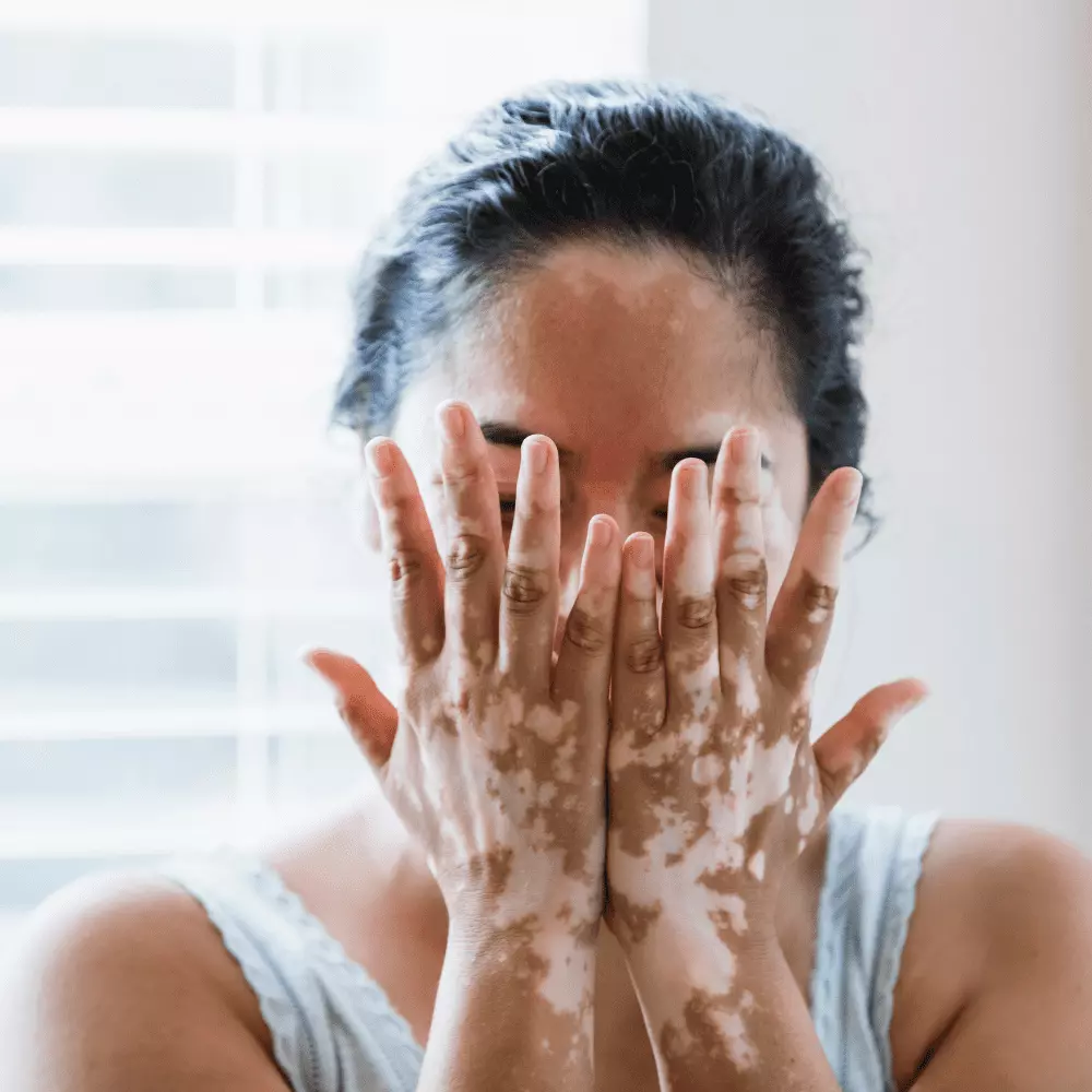 Vitiligo