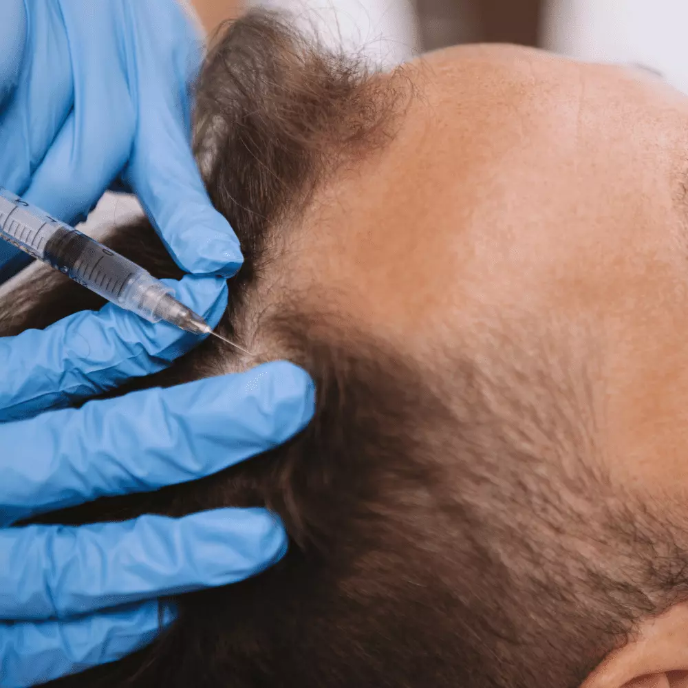 Alopecia